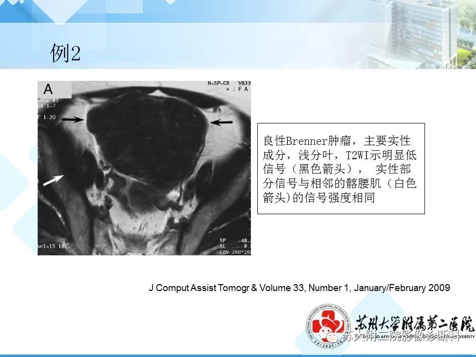 影像PPT - 【病例】卵巢Brenner瘤3例CT及MR影像-31