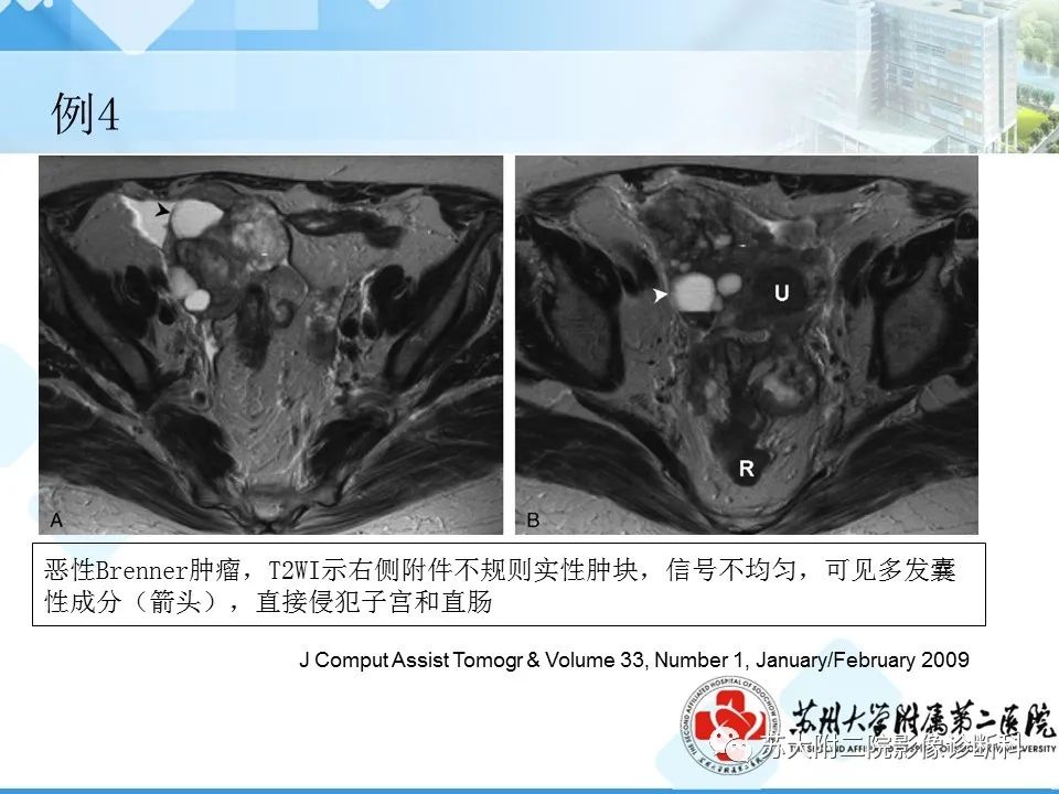 影像PPT - 【病例】卵巢Brenner瘤3例CT及MR影像-33