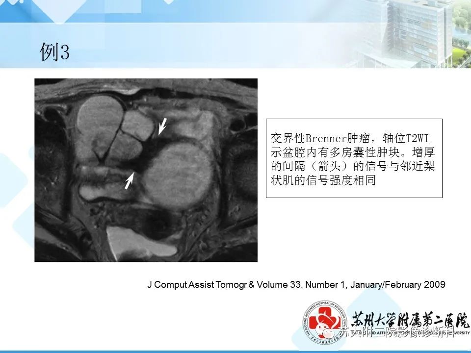 影像PPT - 【病例】卵巢Brenner瘤3例CT及MR影像-32