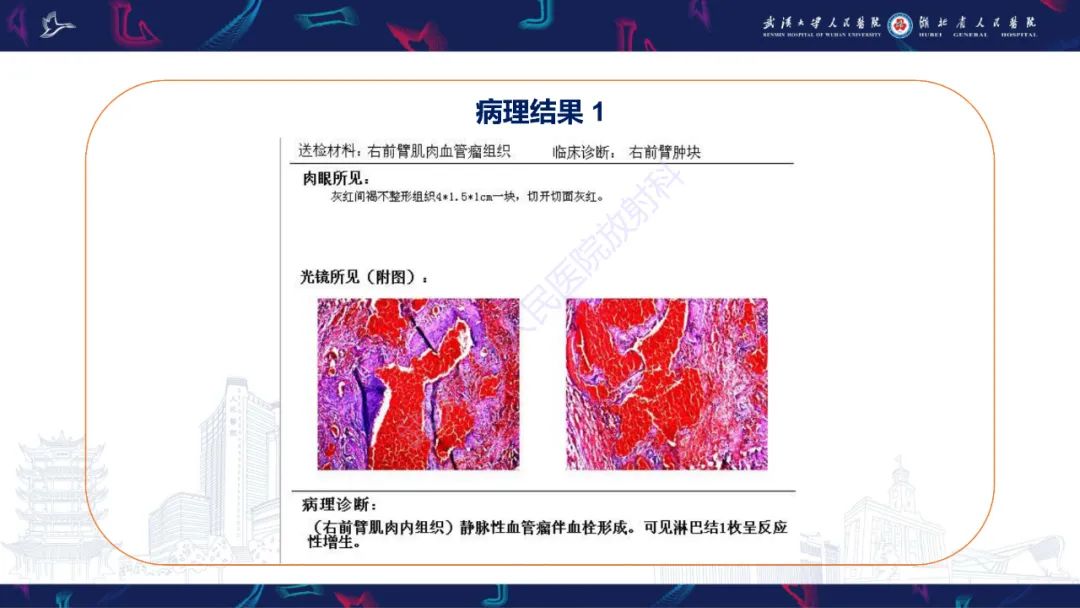 影像PPT - 【PPT】四肢血管源性肿瘤影像诊断-13