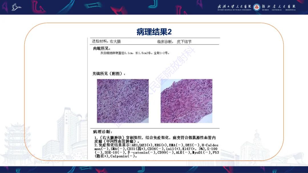 影像PPT - 【PPT】四肢血管源性肿瘤影像诊断-14