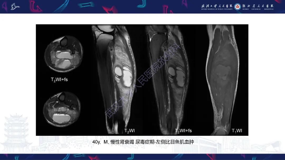 影像PPT - 【PPT】四肢血管源性肿瘤影像诊断-17
