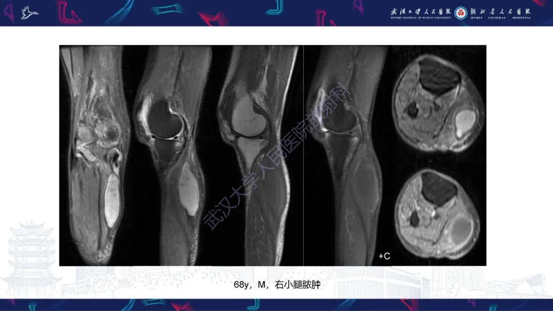 影像PPT - 【PPT】四肢血管源性肿瘤影像诊断-18