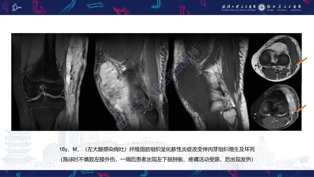 影像PPT - 【PPT】四肢血管源性肿瘤影像诊断-20