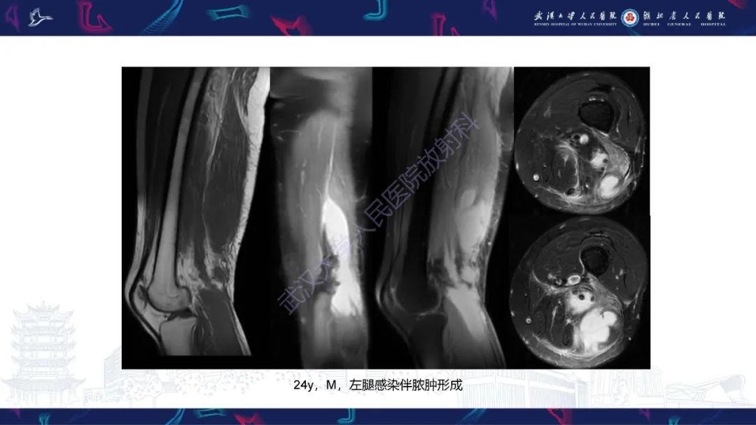 影像PPT - 【PPT】四肢血管源性肿瘤影像诊断-19