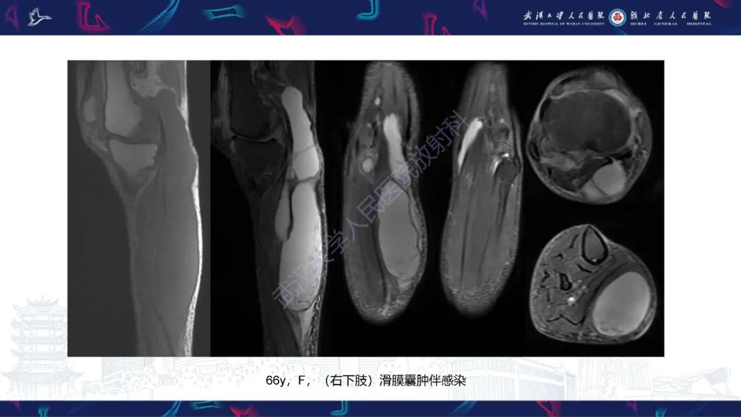 影像PPT - 【PPT】四肢血管源性肿瘤影像诊断-21