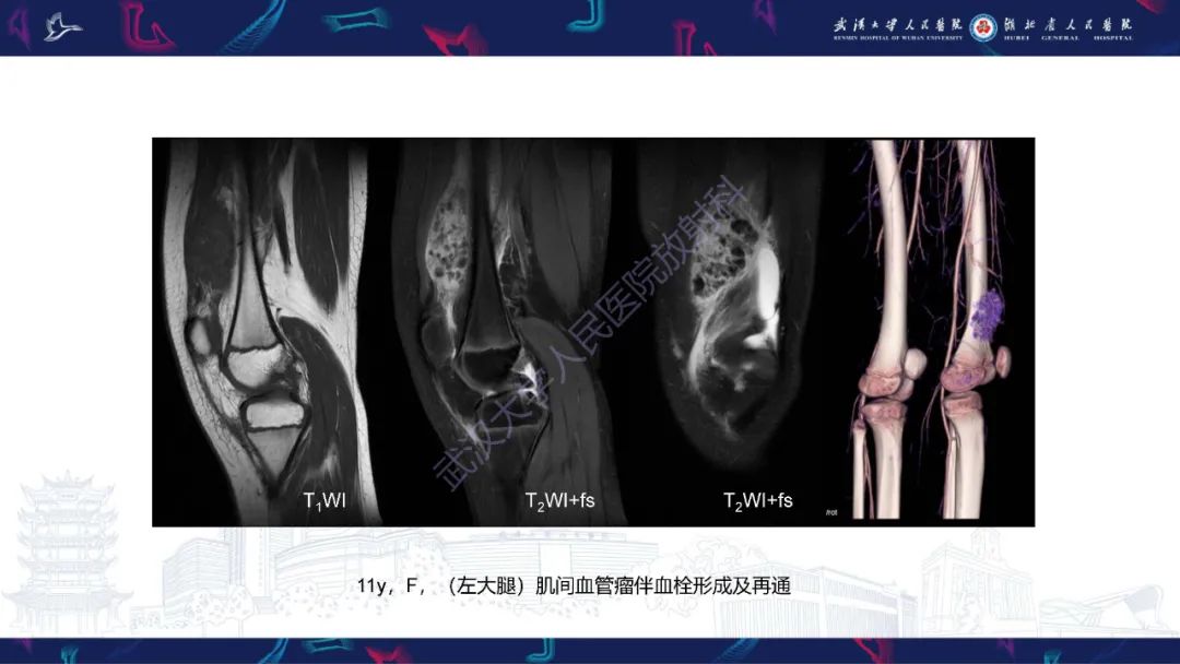 影像PPT - 【PPT】四肢血管源性肿瘤影像诊断-23