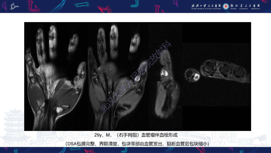 影像PPT - 【PPT】四肢血管源性肿瘤影像诊断-25