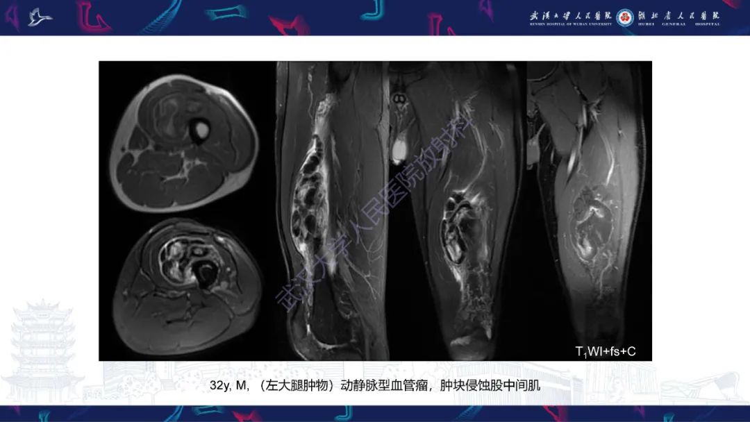 影像PPT - 【PPT】四肢血管源性肿瘤影像诊断-24