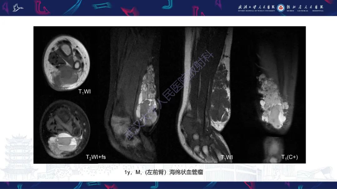 影像PPT - 【PPT】四肢血管源性肿瘤影像诊断-27
