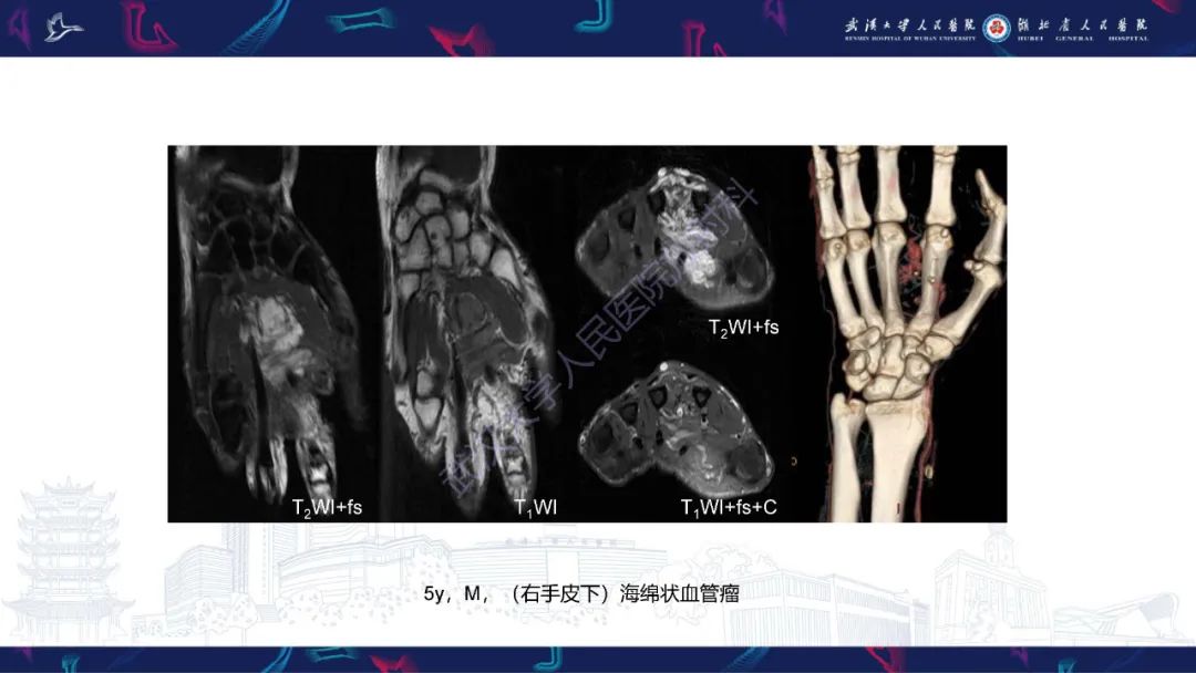 影像PPT - 【PPT】四肢血管源性肿瘤影像诊断-28