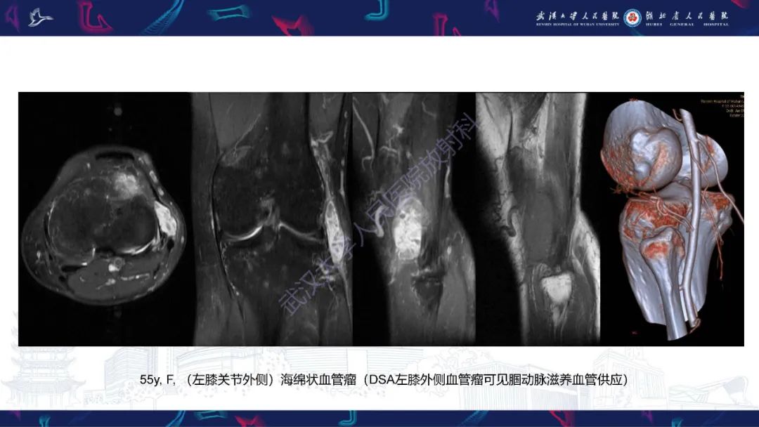 影像PPT - 【PPT】四肢血管源性肿瘤影像诊断-29