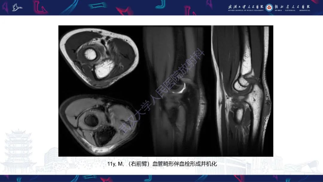 影像PPT - 【PPT】四肢血管源性肿瘤影像诊断-31