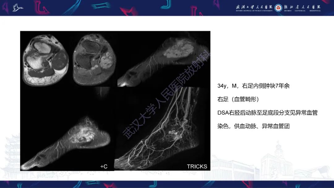 影像PPT - 【PPT】四肢血管源性肿瘤影像诊断-32