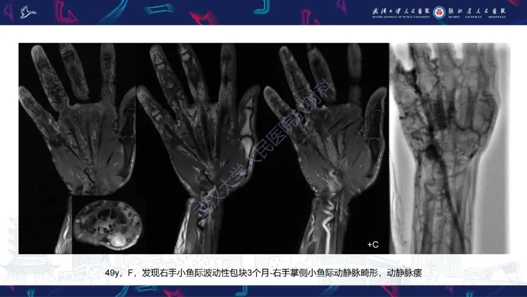 影像PPT - 【PPT】四肢血管源性肿瘤影像诊断-34