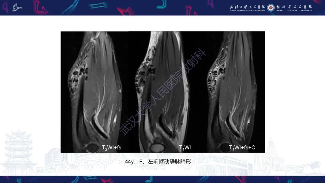 影像PPT - 【PPT】四肢血管源性肿瘤影像诊断-33