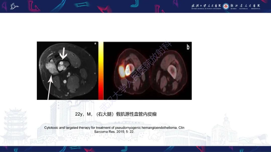 影像PPT - 【PPT】四肢血管源性肿瘤影像诊断-36