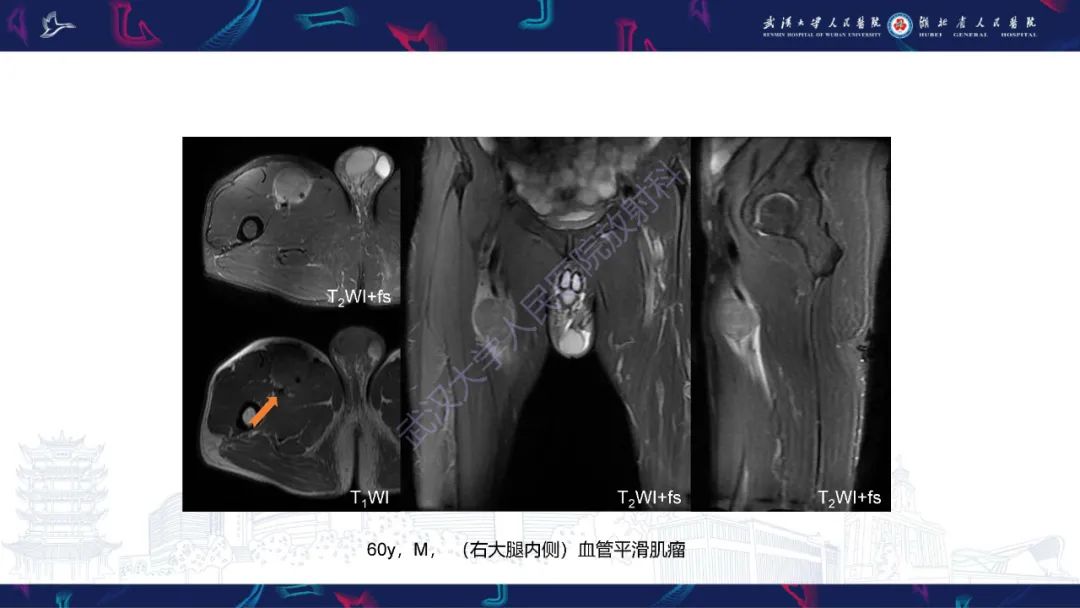 影像PPT - 【PPT】四肢血管源性肿瘤影像诊断-38