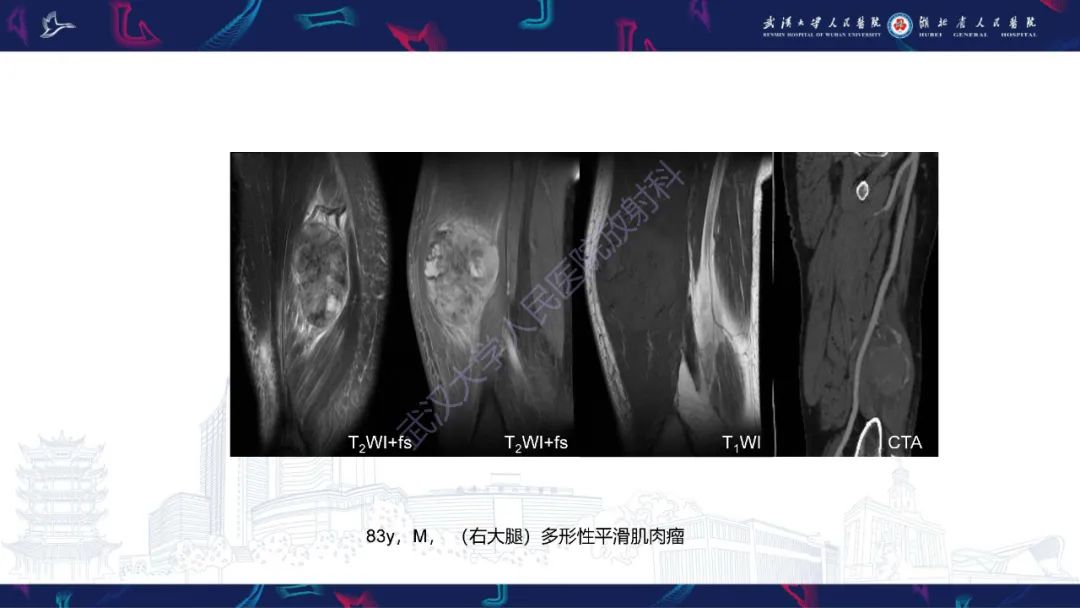影像PPT - 【PPT】四肢血管源性肿瘤影像诊断-40
