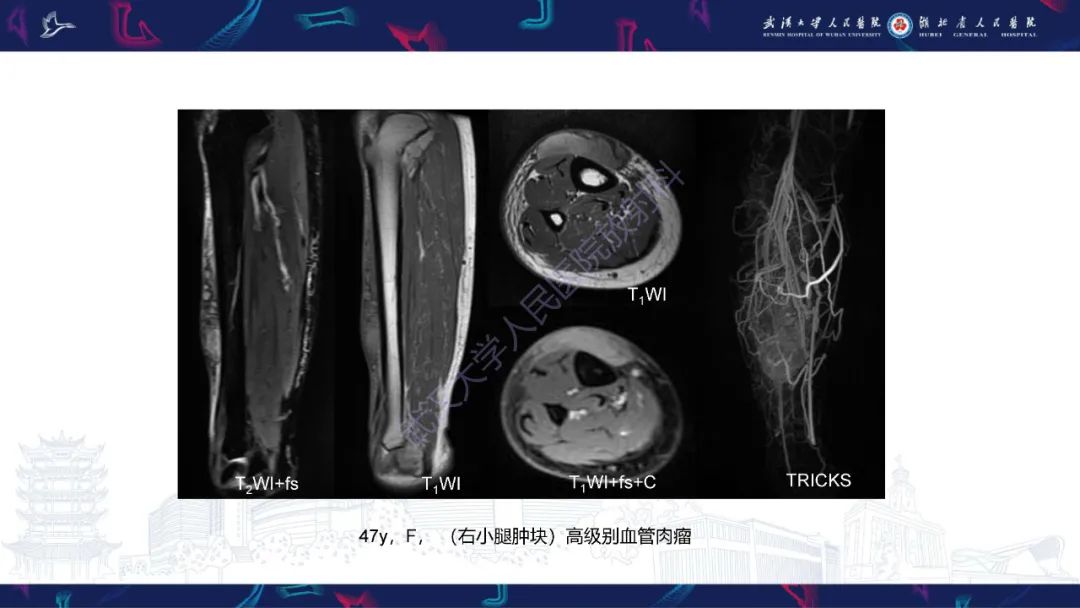 影像PPT - 【PPT】四肢血管源性肿瘤影像诊断-42