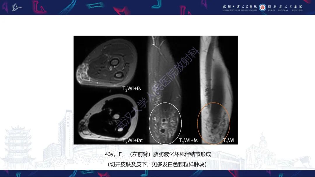 影像PPT - 【PPT】四肢血管源性肿瘤影像诊断-43