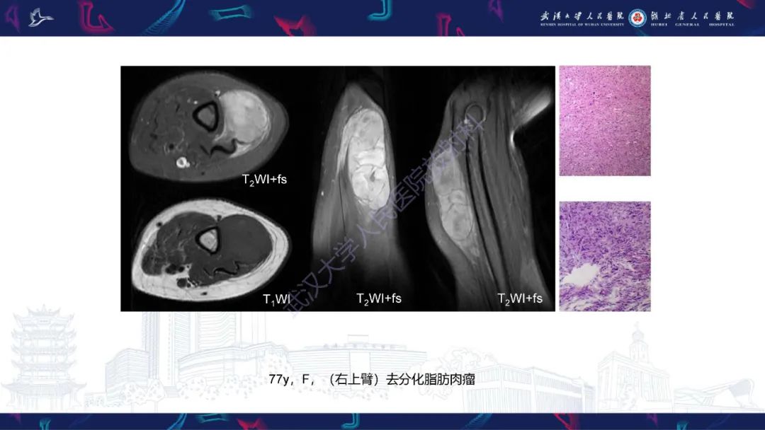 影像PPT - 【PPT】四肢血管源性肿瘤影像诊断-45