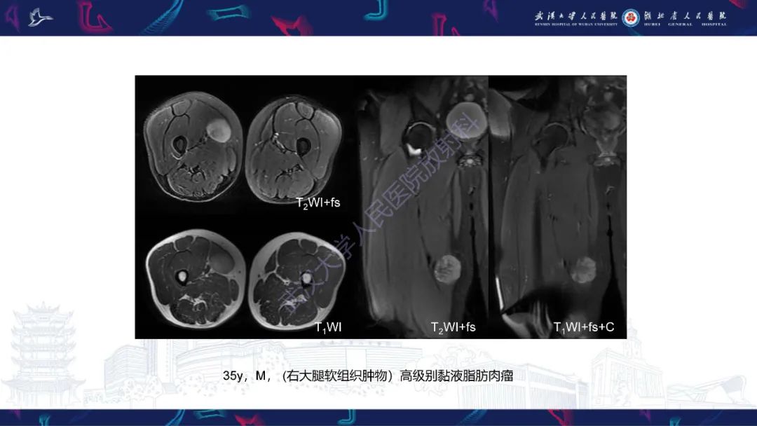 影像PPT - 【PPT】四肢血管源性肿瘤影像诊断-46