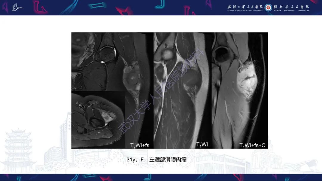 影像PPT - 【PPT】四肢血管源性肿瘤影像诊断-49
