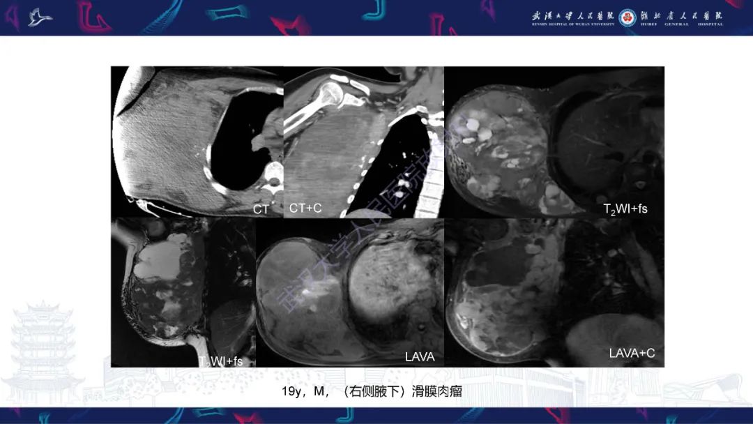 影像PPT - 【PPT】四肢血管源性肿瘤影像诊断-50