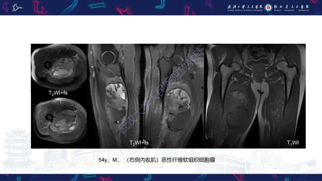 影像PPT - 【PPT】四肢血管源性肿瘤影像诊断-52
