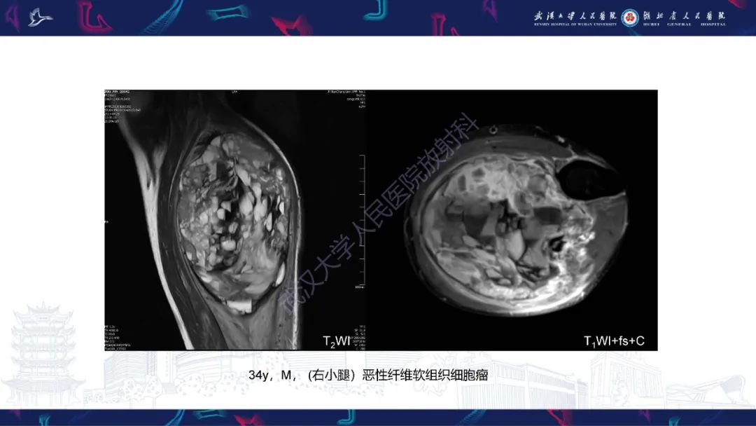 影像PPT - 【PPT】四肢血管源性肿瘤影像诊断-53
