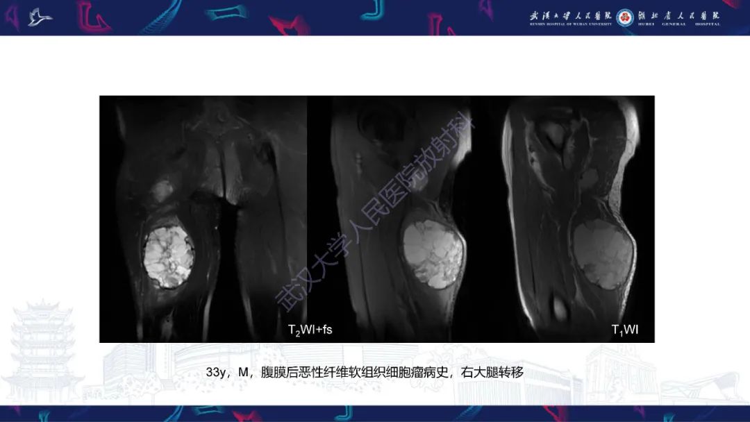 影像PPT - 【PPT】四肢血管源性肿瘤影像诊断-54