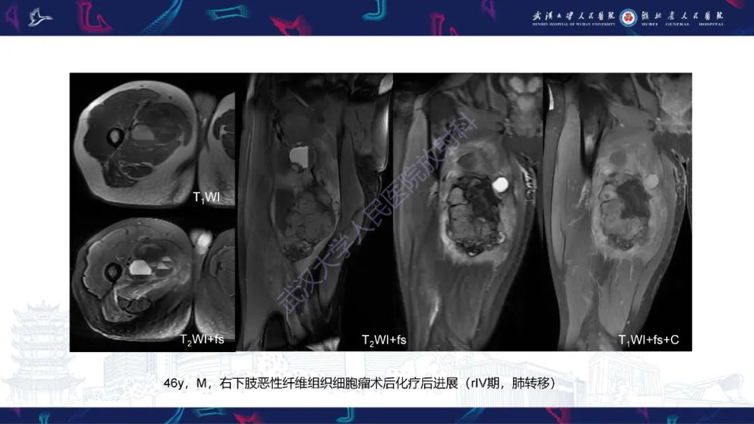 影像PPT - 【PPT】四肢血管源性肿瘤影像诊断-55