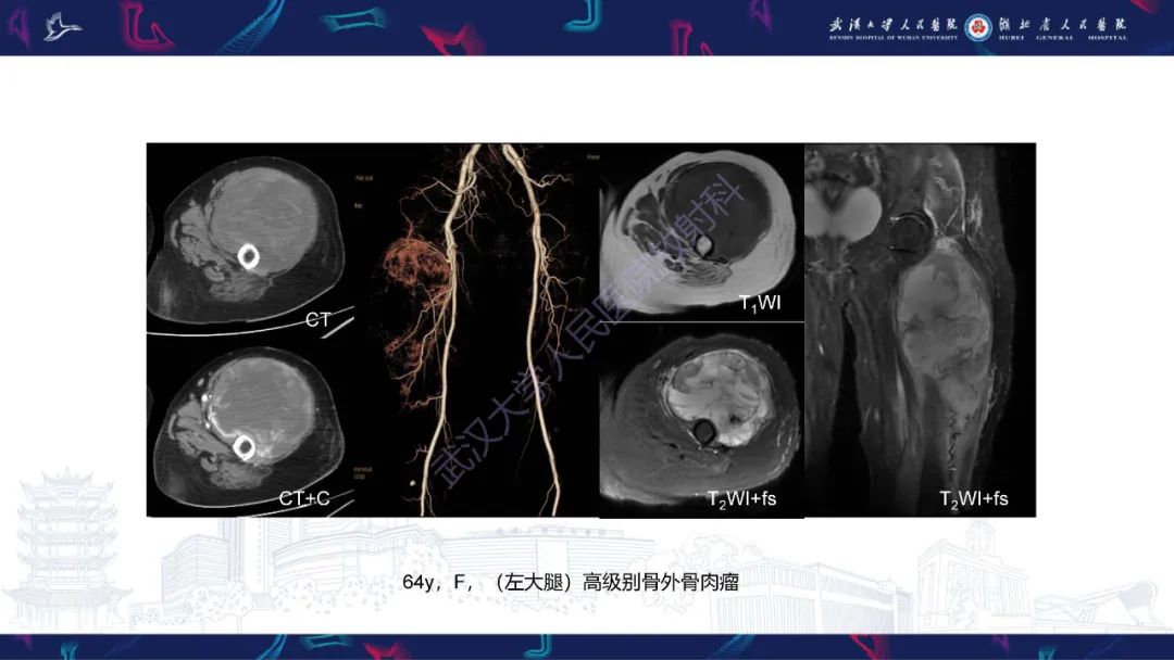 影像PPT - 【PPT】四肢血管源性肿瘤影像诊断-57