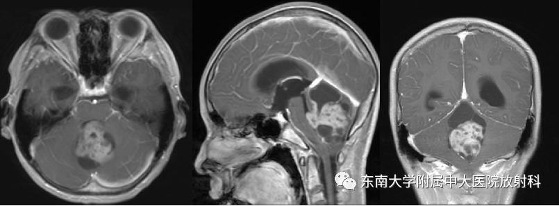 影像PPT - 【PPT】髓母细胞瘤-3