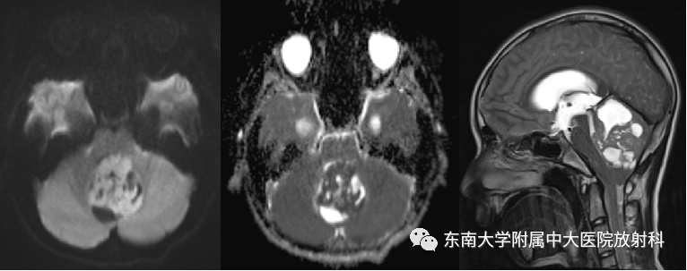 影像PPT - 【PPT】髓母细胞瘤-2