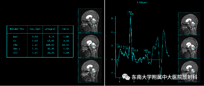 影像PPT - 【PPT】髓母细胞瘤-4