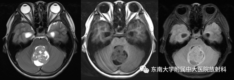 影像PPT - 【PPT】髓母细胞瘤-1