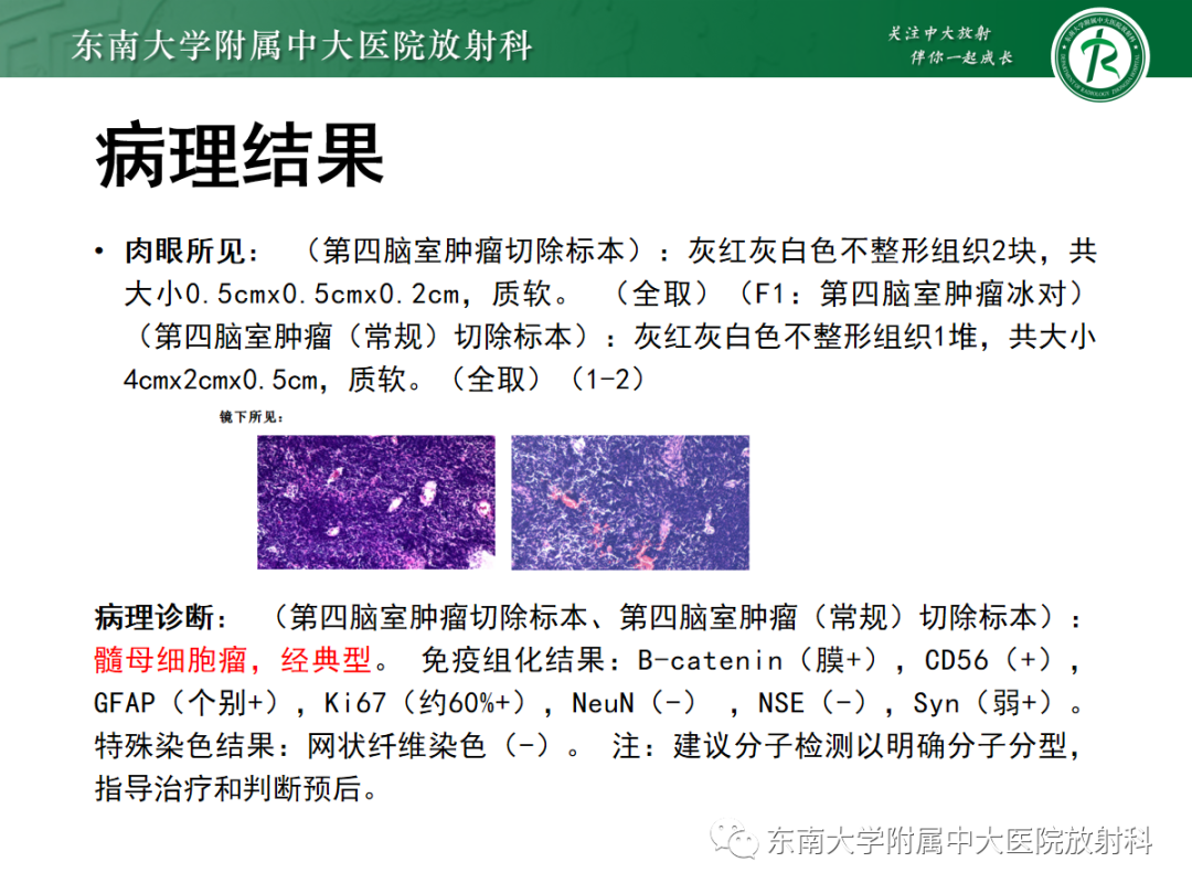 影像PPT - 【PPT】髓母细胞瘤-8