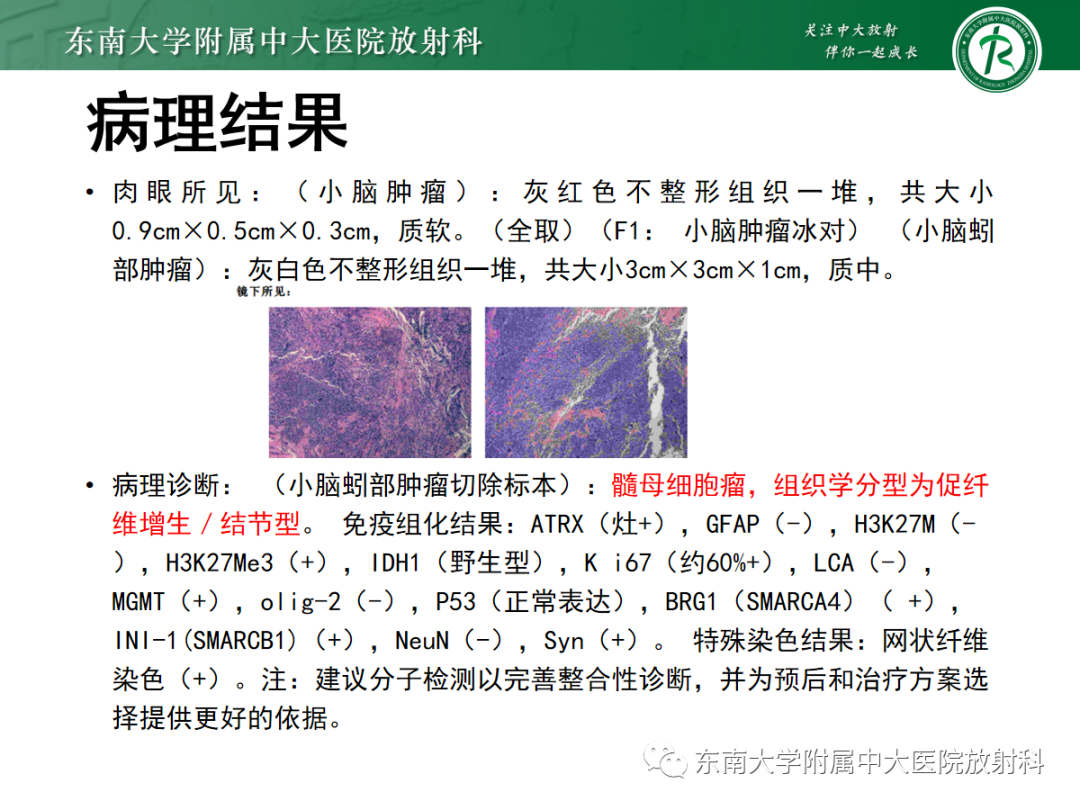 影像PPT - 【PPT】髓母细胞瘤-10