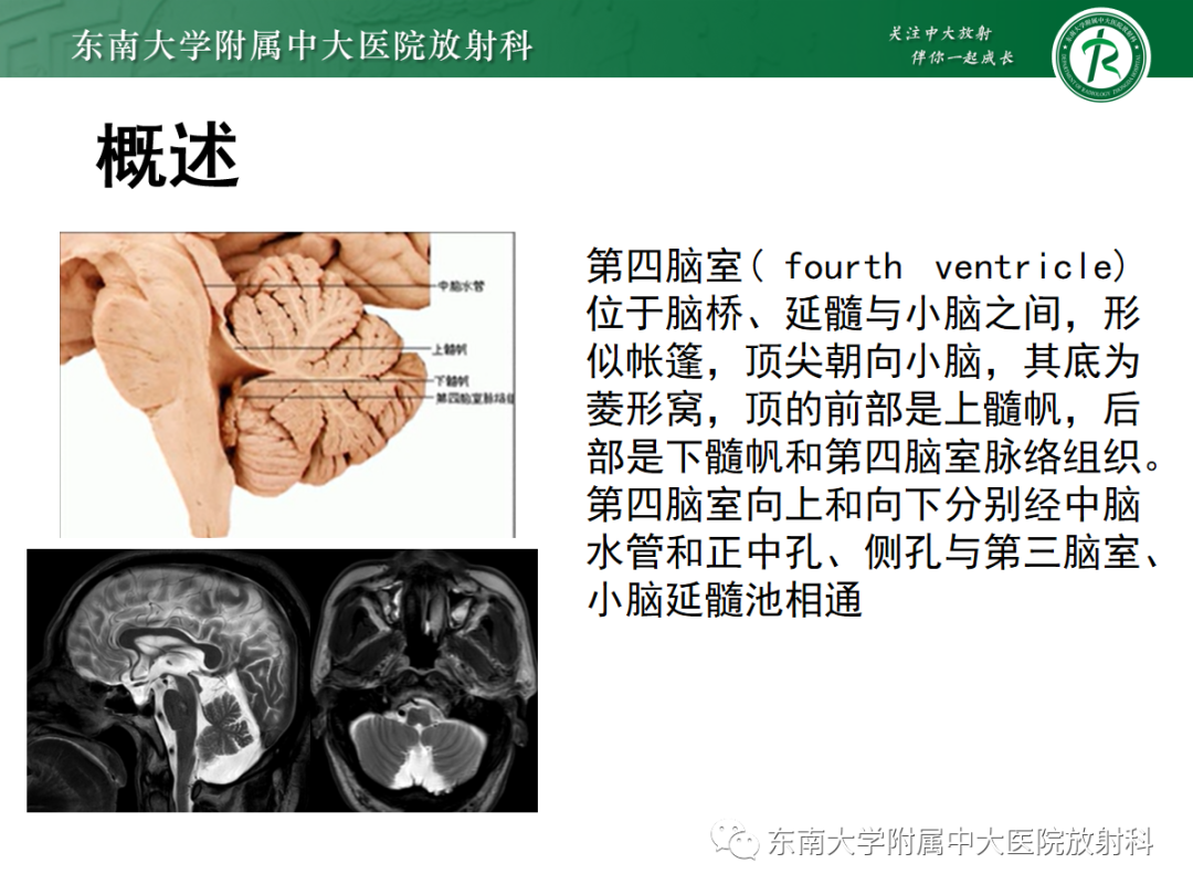 影像PPT - 【PPT】髓母细胞瘤-12