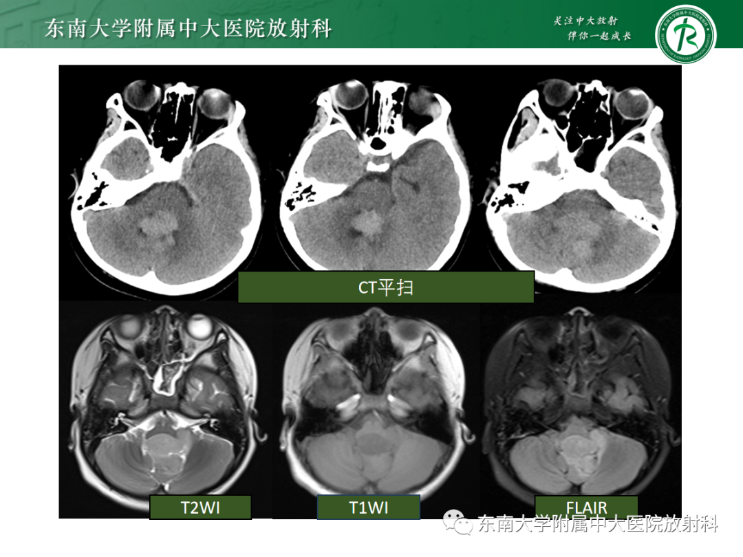 影像PPT - 【PPT】髓母细胞瘤-21