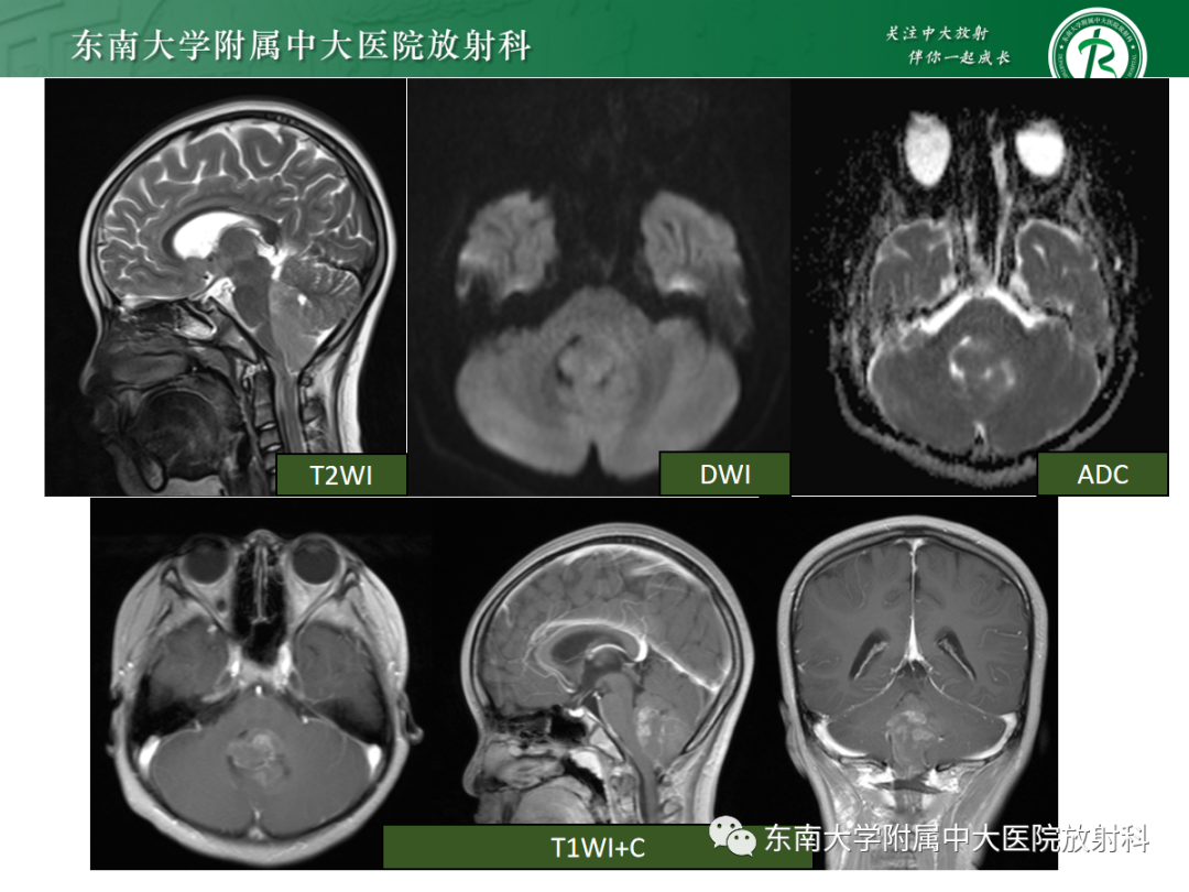 影像PPT - 【PPT】髓母细胞瘤-22