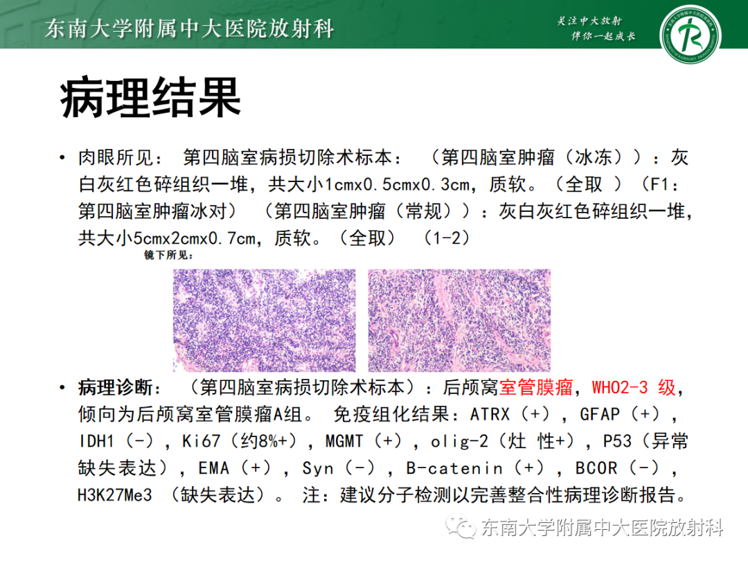影像PPT - 【PPT】髓母细胞瘤-24