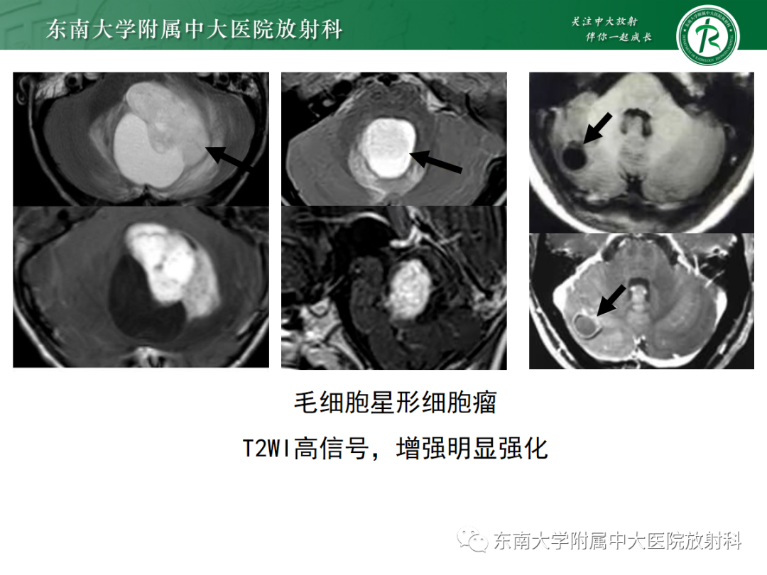 影像PPT - 【PPT】髓母细胞瘤-29