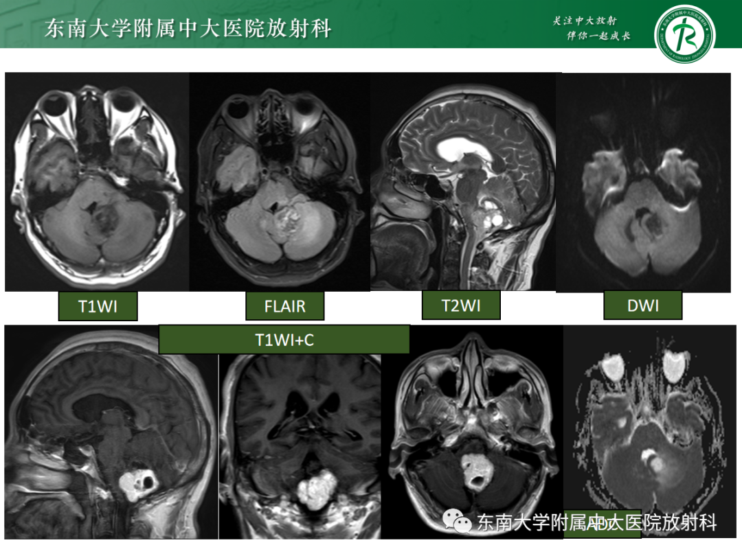 影像PPT - 【PPT】髓母细胞瘤-31