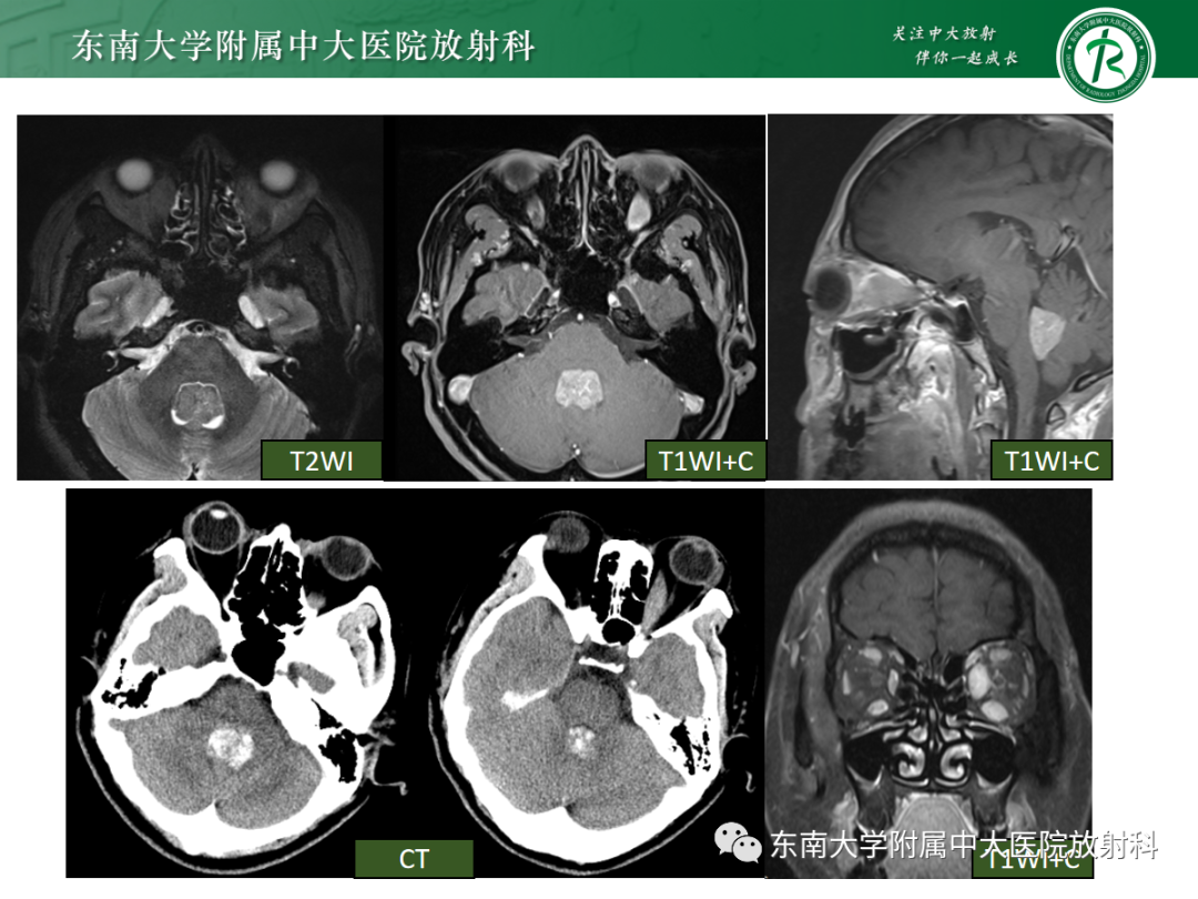 影像PPT - 【PPT】髓母细胞瘤-37