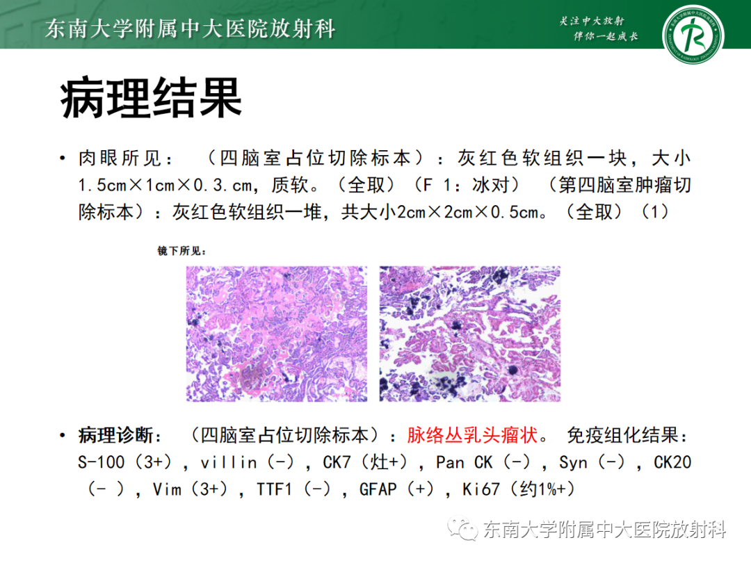 影像PPT - 【PPT】髓母细胞瘤-39
