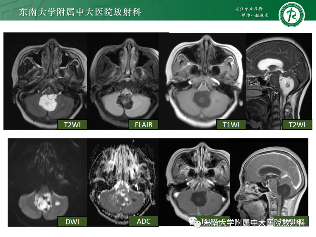 影像PPT - 【PPT】髓母细胞瘤-42