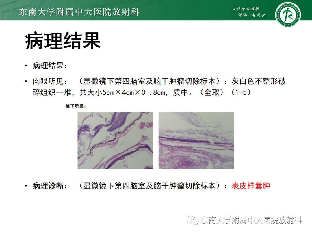影像PPT - 【PPT】髓母细胞瘤-44
